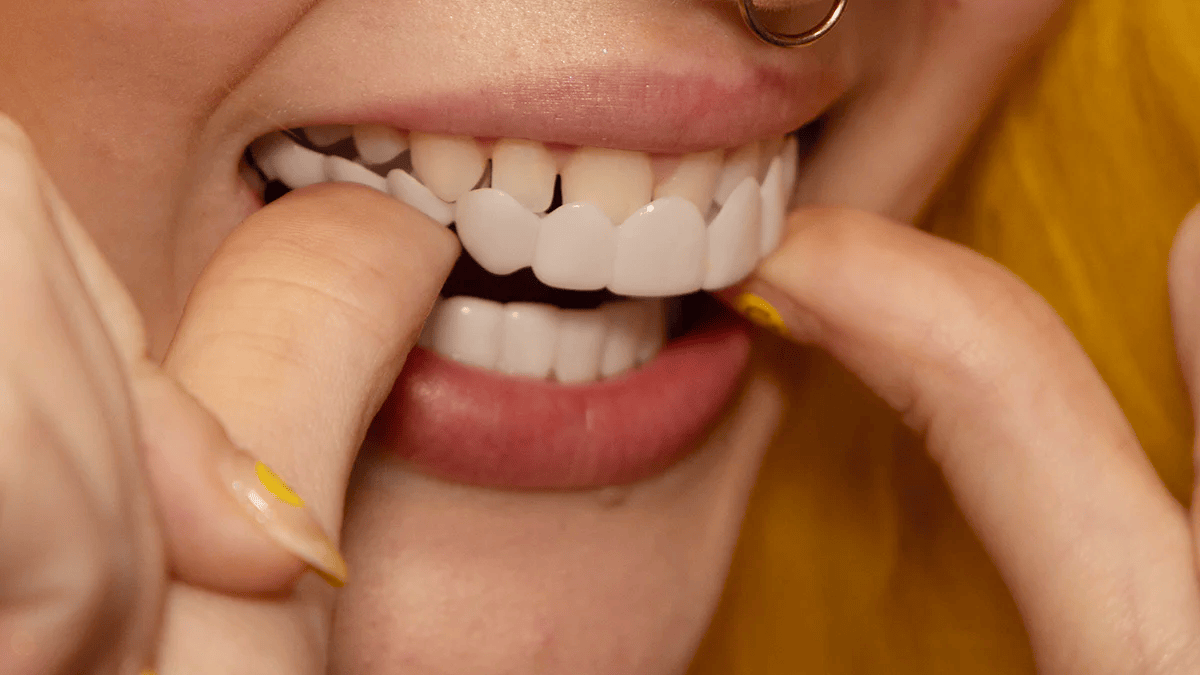 Instant Smile Veneer Set - Removable Upper and Lower Teeth Veneers