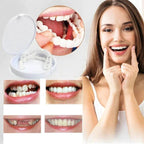 Instant Smile Veneer Set - Removable Upper and Lower Teeth Veneers