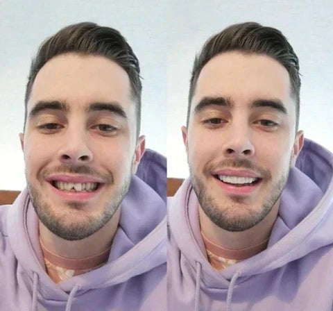 Instant Smile Veneer Set - Removable Upper and Lower Teeth Veneers