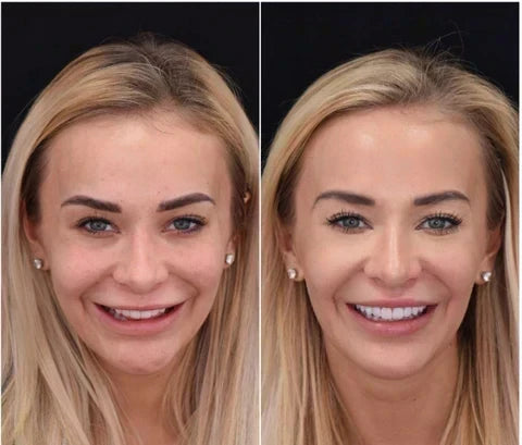 Instant Smile Veneer Set - Removable Upper and Lower Teeth Veneers