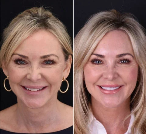 Instant Smile Veneer Set - Removable Upper and Lower Teeth Veneers