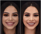 Instant Smile Veneer Set - Removable Upper and Lower Teeth Veneers